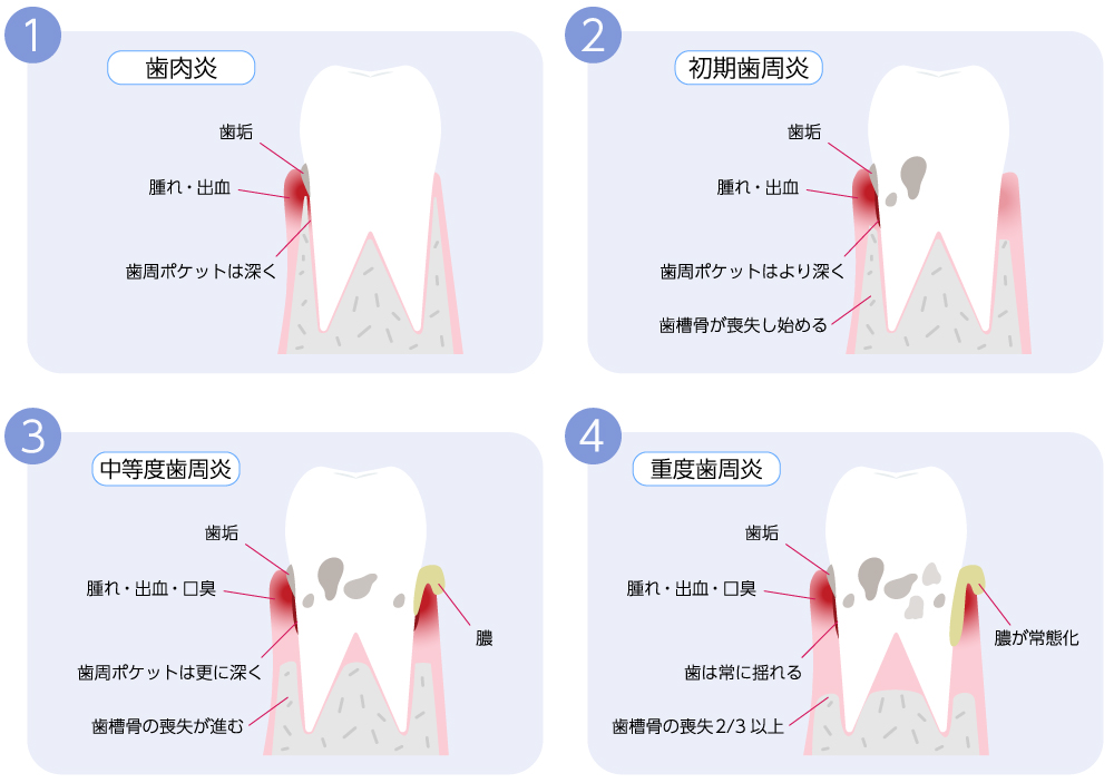歯周病の進行のイメージイラスト